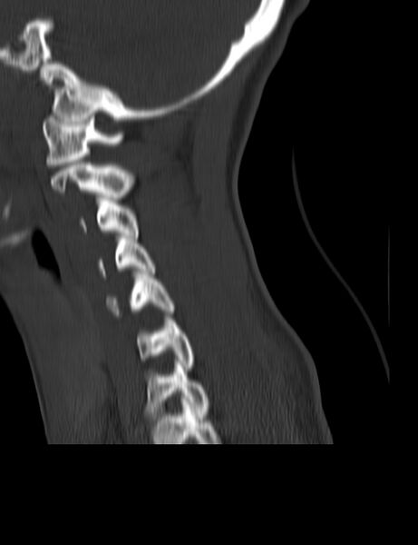 File:Cervical spine posterior ligamentous complex rupture (Radiopaedia 63486-72101 Sagittal bone window 6).jpg
