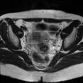 Cesarian section scar endometriosis (Radiopaedia 66520-75799 Axial T2 11).jpg