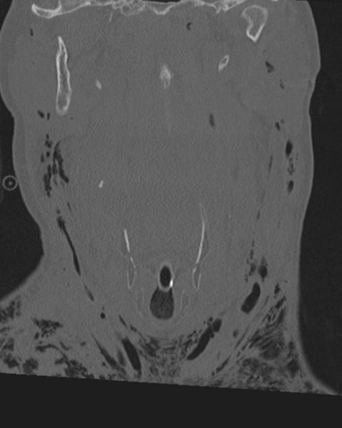 File:Chalk stick fracture (Radiopaedia 57948-64928 Coronal bone window 16).png