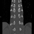 Chance fracture (Radiopaedia 36521-38081 Coronal bone window 41).jpg