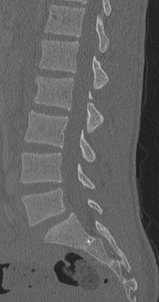 File:Chance fracture (Radiopaedia 40360-42912 Sagittal bone window 48).png