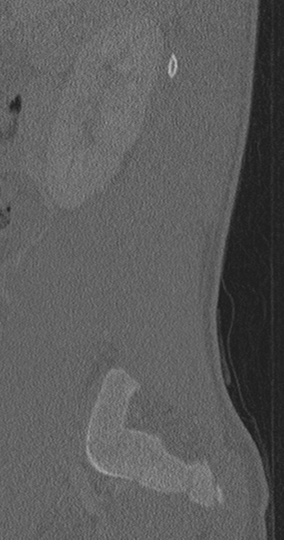 File:Chance fracture (Radiopaedia 40360-42912 Sagittal bone window 80).png