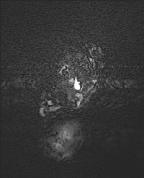File:Chiari III malformation with occipital encephalocele (Radiopaedia 79446-92559 Axial SWI 2).jpg