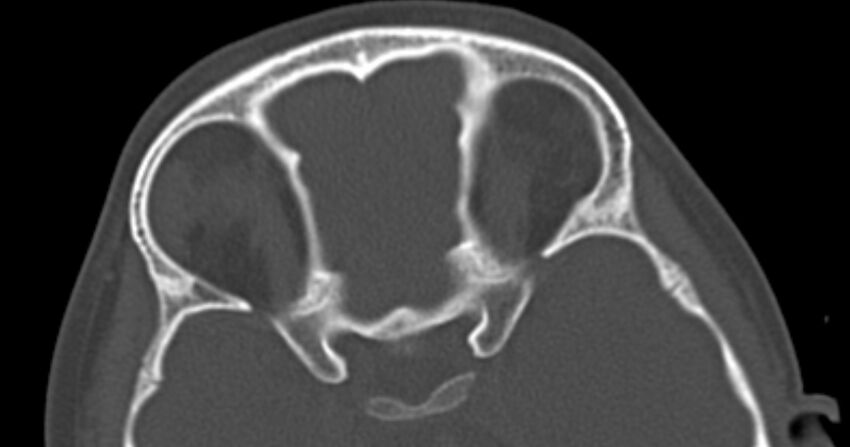 Choanal atresia (Radiopaedia 51295-56972 Axial bone window 59).jpg
