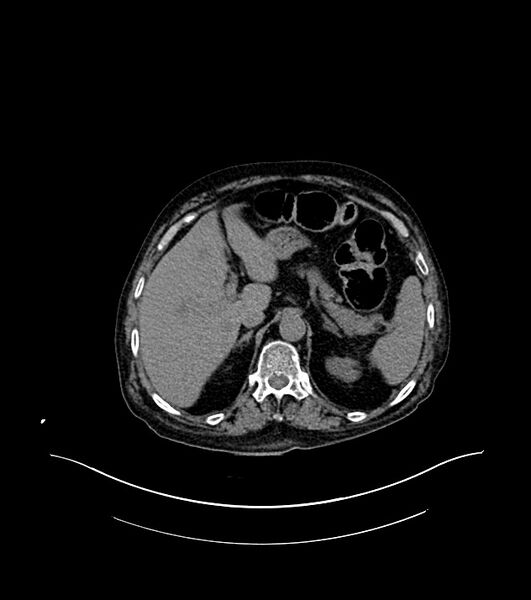 File:Cholangiocarcinoma with cerebral metastases (Radiopaedia 83519-98629 Axial non-contrast 24).jpg