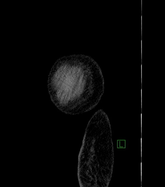 File:Cholangiocarcinoma with cerebral metastases (Radiopaedia 83519-98629 F 4).jpg