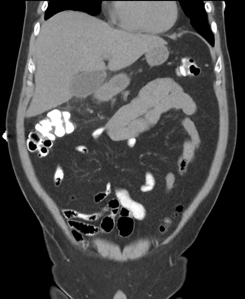 File:Cholecystitis with focal perforation and hepatic abscess (Radiopaedia 37189-38945 Coronal non-contrast 19).png