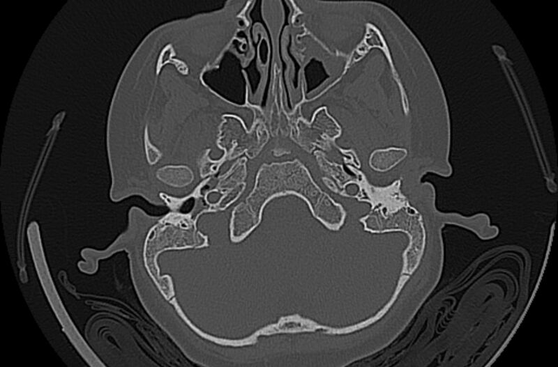 File:Cholesteatoma (Radiopaedia 73023-83750 Axial bone window 18).jpg