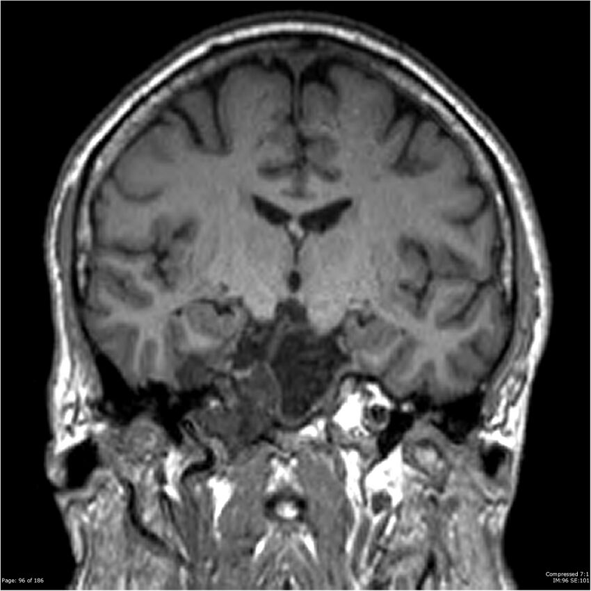 Chondrosarcoma of skull base- grade II (Radiopaedia 40948-43654 Coronal T1 17).jpg
