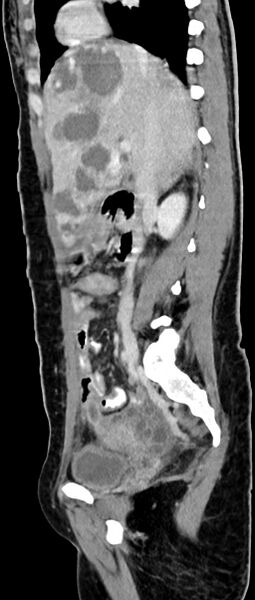 File:Choriocarcinoma liver metastases (Radiopaedia 74768-85766 C 112).jpg