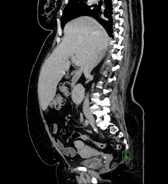 File:Chromophobe renal cell carcinoma (Radiopaedia 84239-99519 G 72).jpg