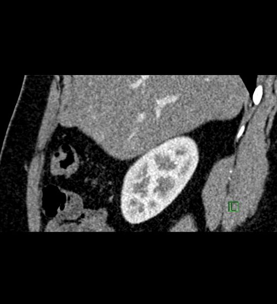 File:Chromophobe renal cell carcinoma (Radiopaedia 84286-99573 F 129).jpg