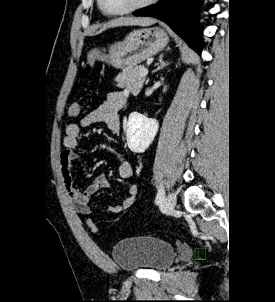File:Chromophobe renal cell carcinoma (Radiopaedia 84286-99573 I 69).jpg