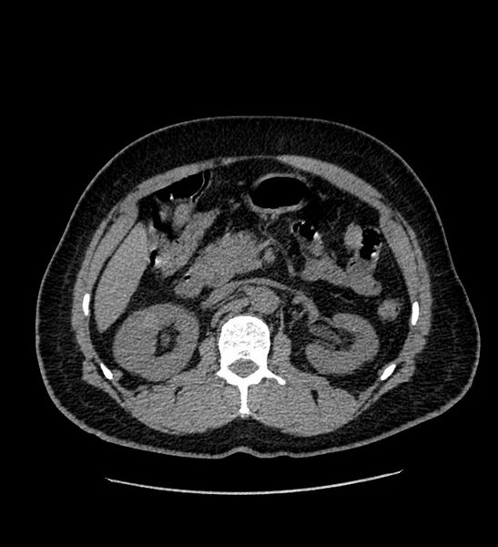 File:Chromophobe renal cell carcinoma (Radiopaedia 84337-99693 Axial non-contrast 49).jpg
