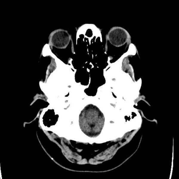 File:Chronic bilateral occipital lobe infarcts (Radiopaedia 31276-31996 Axial non-contrast 6).jpg