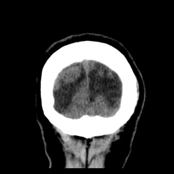 File:Chronic bilateral occipital lobe infarcts (Radiopaedia 31276-31996 Coronal non-contrast 44).jpg