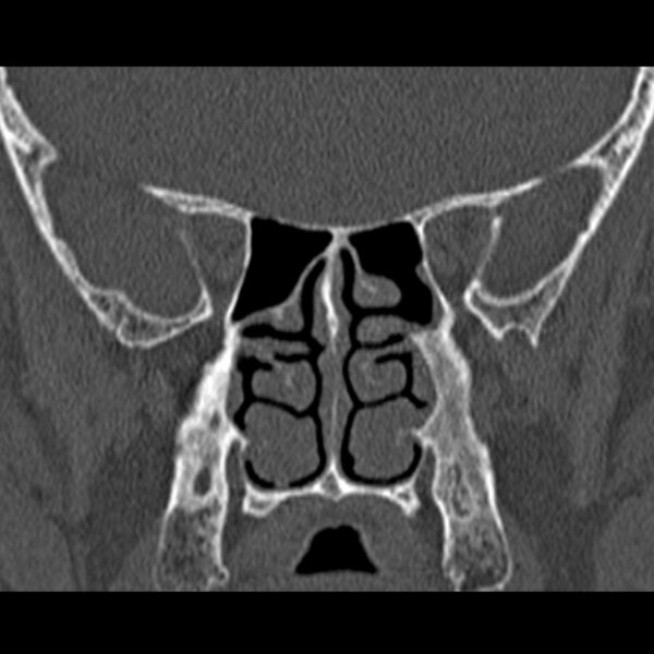 File:Chronic maxillary sinusitis (Radiopaedia 27879-28116 Coronal bone window 36).jpg