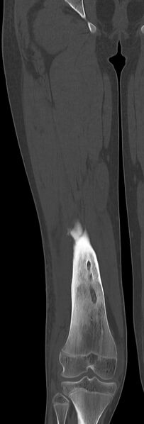 File:Chronic ostemyelitis of the femur with long sinus tract (Radiopaedia 74947-85982 Coronal bone window 48).jpg