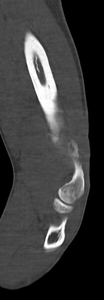 File:Chronic osteomyelitis of the distal humerus (Radiopaedia 78351-90971 Sagittal bone window 46).jpg