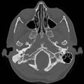 Chronic otomastoiditis (Radiopaedia 27138-27309 Axial bone window 8).jpg