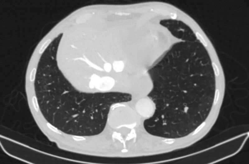 File:Chronic pulmonary embolism (Radiopaedia 91241-108843 Axial lung window 77).jpg