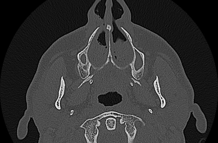 Chronic rhinosinusitis (Radiopaedia 65079-74075 Axial bone window 9).jpg
