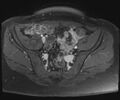 Class II Mullerian duct anomaly- unicornuate uterus with rudimentary horn and non-communicating cavity (Radiopaedia 39441-41755 Axial T1 fat sat 31).jpg