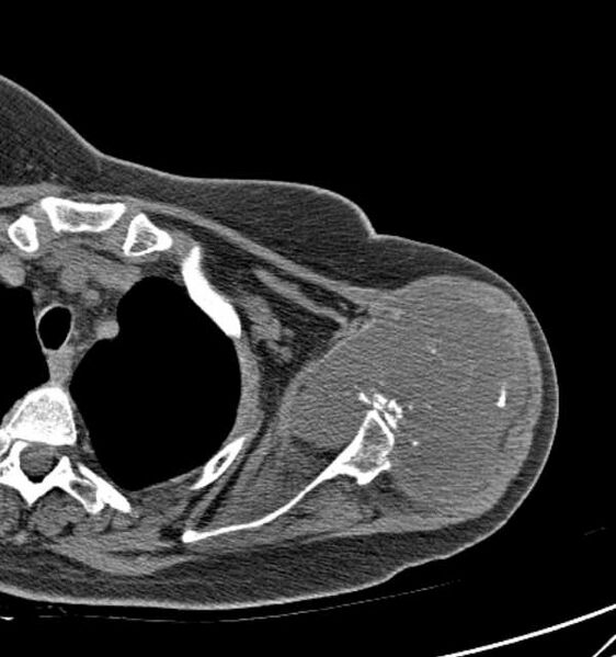 File:Clear cell chondrosarcoma - humerus (Radiopaedia 63104-71612 Axial non-contrast 40).jpg