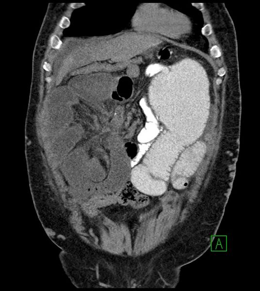 File:Closed-loop small bowel obstruction-internal hernia (Radiopaedia 78439-91096 Coronal non-contrast 30).jpg
