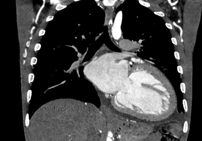 File:Coarctation of aorta with aortic valve stenosis (Radiopaedia 70463-80574 C 133).jpg