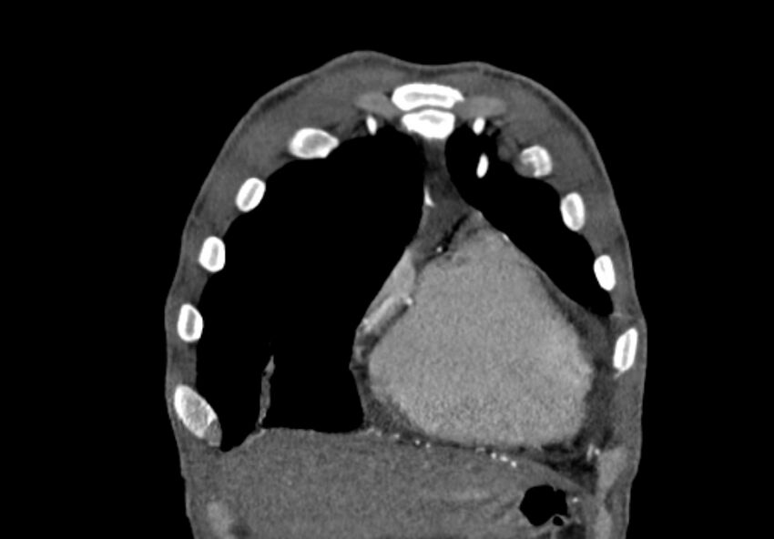 Coarctation of aorta with aortic valve stenosis (Radiopaedia 70463-80574 C 18).jpg