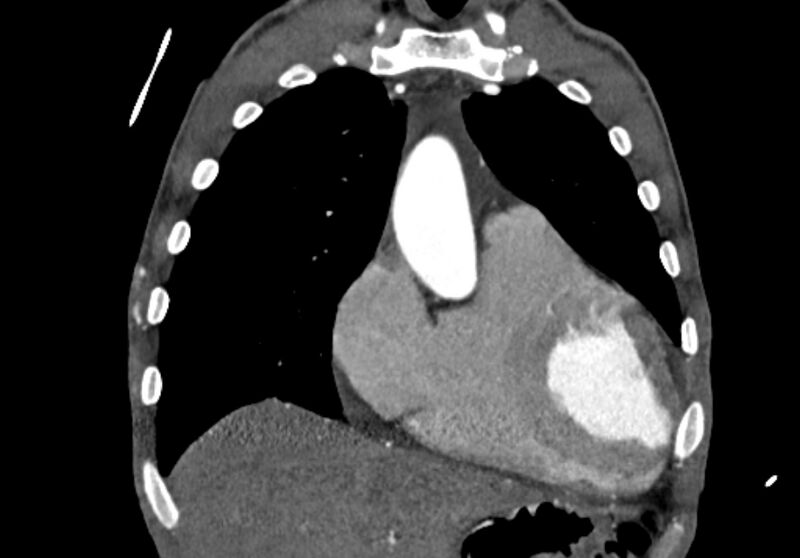 File:Coarctation of aorta with aortic valve stenosis (Radiopaedia 70463-80574 C 48).jpg