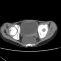 Colocolic fistula - Crohn disease (Radiopaedia 57063-63955 A 83).jpg