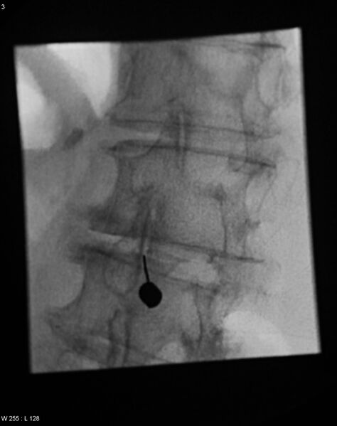 File:Facet joint injection - Scotty dog (Radiopaedia 36087).jpg