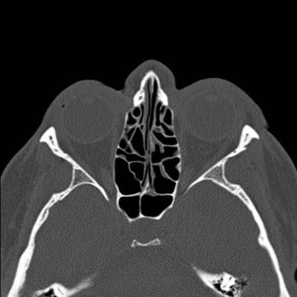 File:Nasal septal perforation (Radiopaedia 25030-25289 Axial bone window 39).jpg