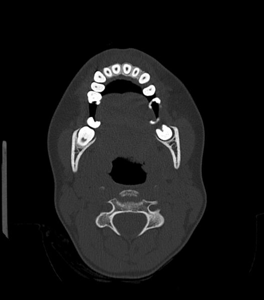 File:Nasoorbitoethmoid fracture (Radiopaedia 90044-107205 Axial bone window 39).jpg