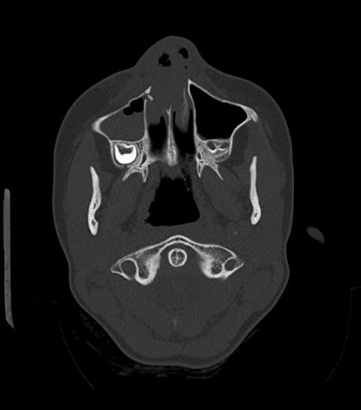 File:Nasoorbitoethmoid fracture (Radiopaedia 90044-107205 Axial bone window 56).jpg