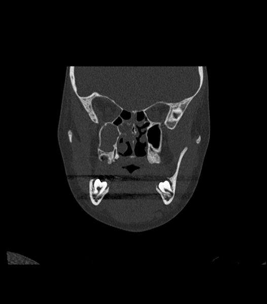 File:Nasoorbitoethmoid fracture (Radiopaedia 90044-107205 Coronal bone window 60).jpg
