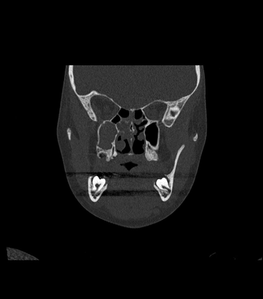 Nasoorbitoethmoid fracture (Radiopaedia 90044-107205 Coronal bone window 60).jpg
