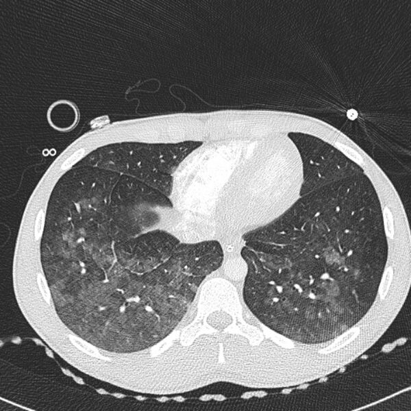 File:Near drowning (pulmonary edema) (Radiopaedia 24685-24958 lung window 63).jpg