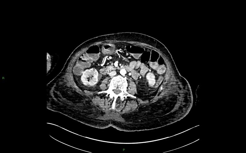 Neo-terminal ileal stricture (Crohn disease) (Radiopaedia 33790-34948 A 210).jpg