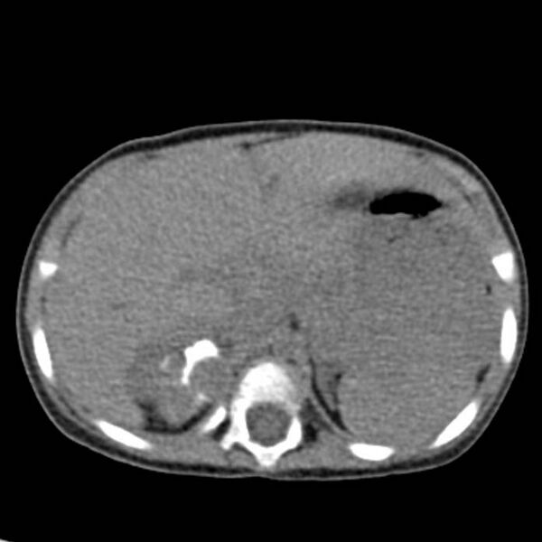 File:Neuroblastoma with skull metastases (Radiopaedia 30326-30960 Axial non-contrast 16).jpg
