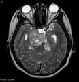 Neurofibromatosis type 2 - cranial and spinal involvement (Radiopaedia 5351-7111 Axial T2 8).jpg