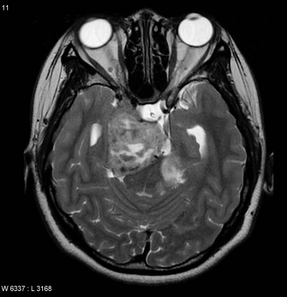 File:Neurofibromatosis type 2 - cranial and spinal involvement (Radiopaedia 5351-7111 Axial T2 8).jpg