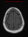 Neuroglial cyst (Radiopaedia 10713-11184 Axial FLAIR 3).jpg