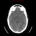 Neuroglial cyst (Radiopaedia 10713-11185 Axial non-contrast 19).jpg