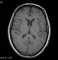 Neurosarcoidosis (Radiopaedia 10930-17204 Axial T1 11).jpg