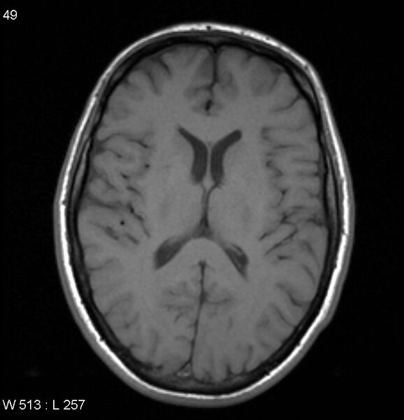 File:Neurosarcoidosis (Radiopaedia 10930-17204 Axial T1 11).jpg