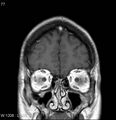 Neurosarcoidosis (Radiopaedia 10930-17204 Coronal T1 C+ 1).jpg