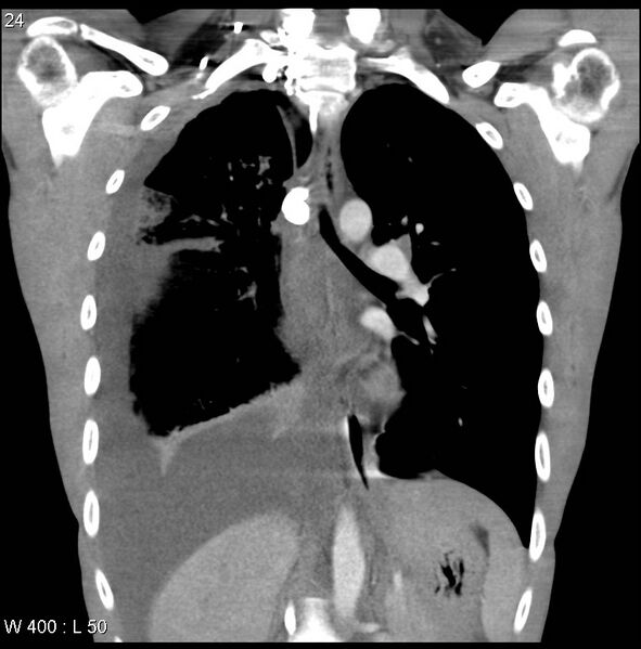 File:Non-Hodgkin lymphoma involving lung (Radiopaedia 29094-29470 C 18).jpg